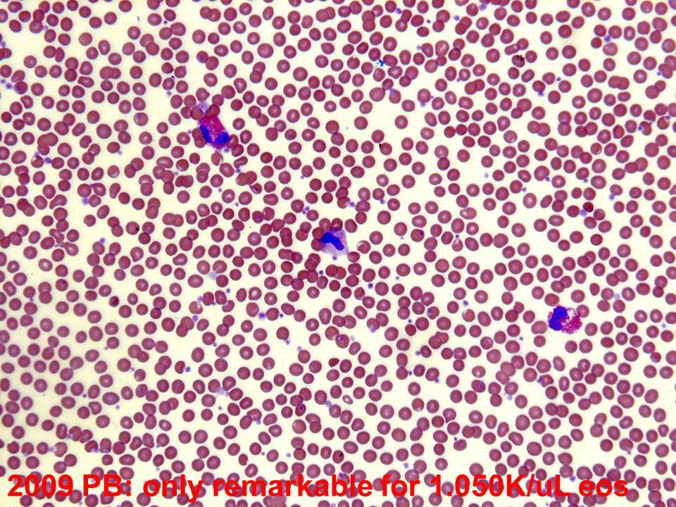 2009 peripheral blood smear remarkable only for eosinophilia