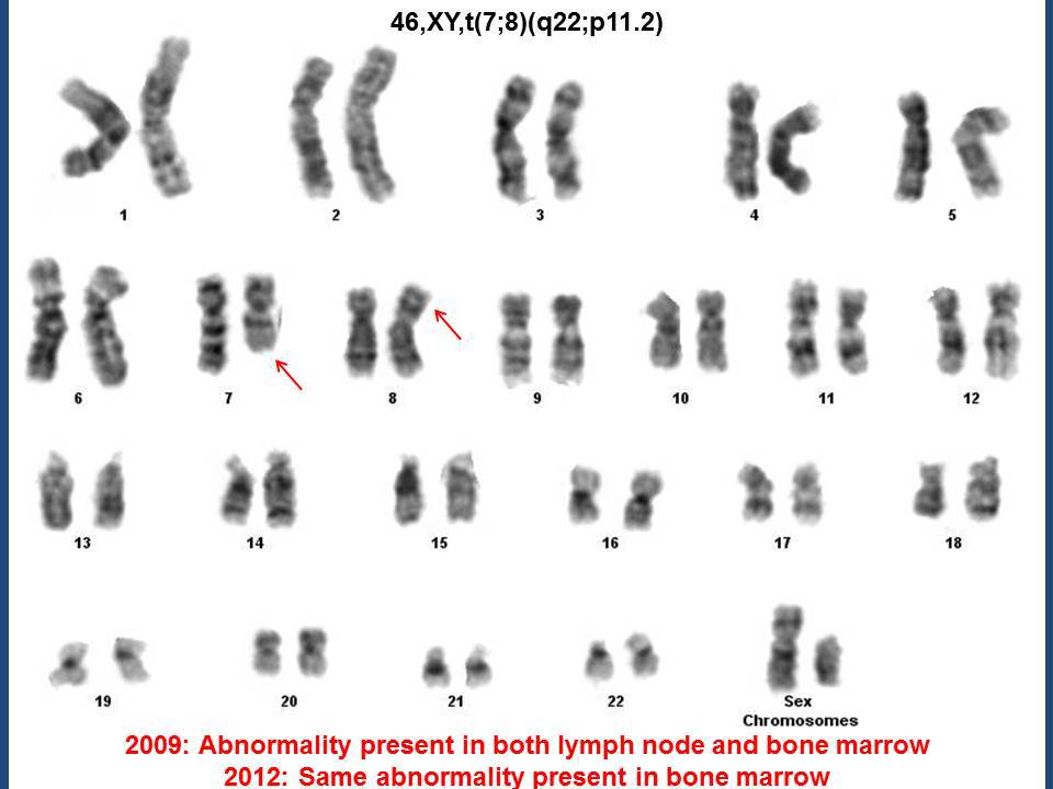 Karyogram showing t(7;8)(q22;p11.2), present in the lymph node and marrow in 2009, and in the marrow in 2012