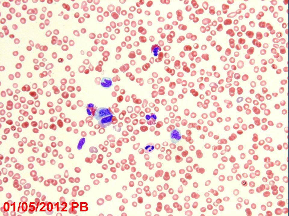 2012 peripheral blood smear showing shift to immaturity, monocytosis and eosinophilia