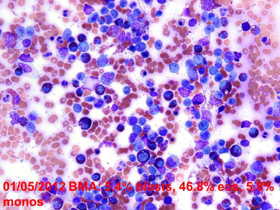 2012 bone marrow aspirate with mildly increased blasts but markedly increased eosinophils