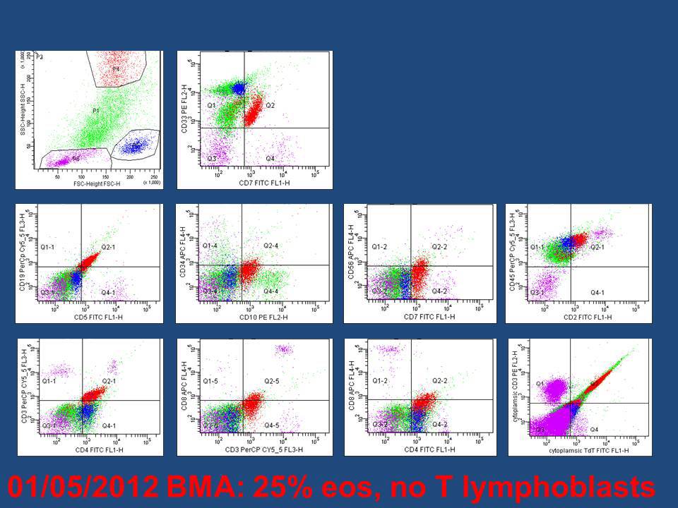 2012 flow cytometry of bone marrow aspirate with large population of eosinophils but no evidence of previously diagnosed T lymphoblastic lymphoma