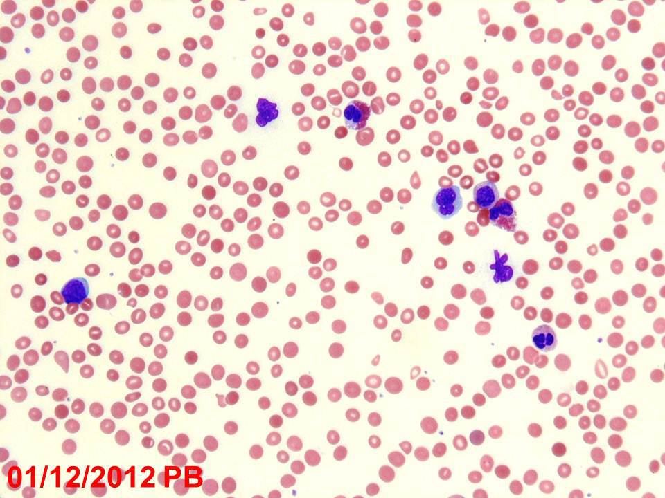 2012 peripheral blood smear (one week later) with similar findings