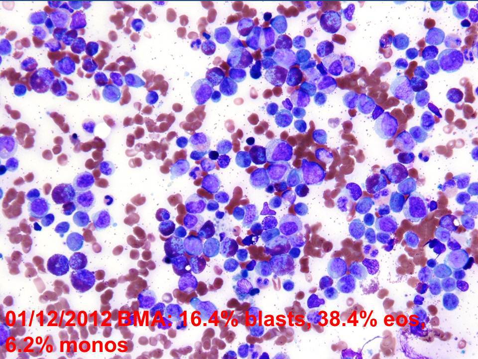 2012 bone marrow aspirate (one week later) with fewer eosinophils but a greater number of blasts