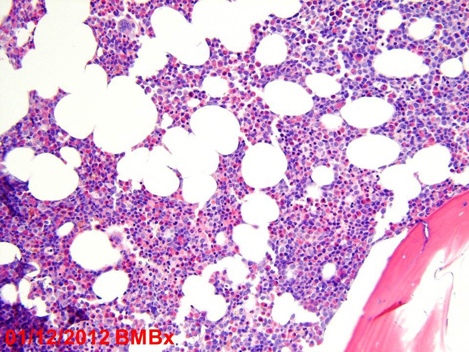 2012 bone marrow trephine biopsy (one week later) with 70% cellularity, myeloid hyperplasia, shift to immaturity and eosinophilia