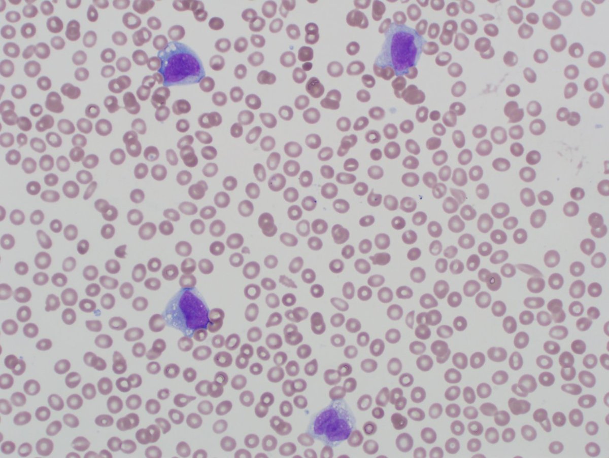 Peripheral blood at the time of diagnosis