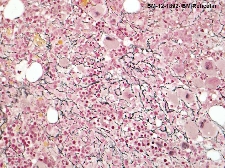 Second BM Biopsy Reticulin