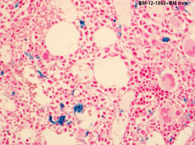 Second BM Biopsy Iron