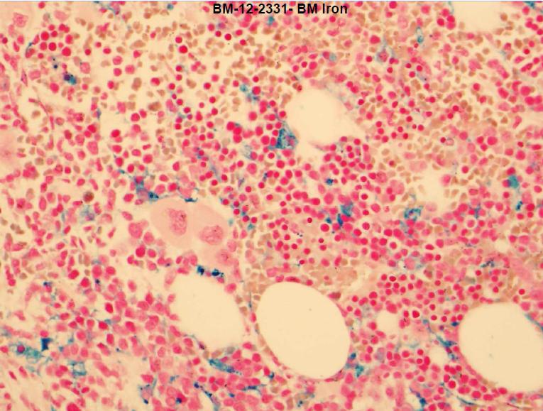 Third BM Biopsy Iron