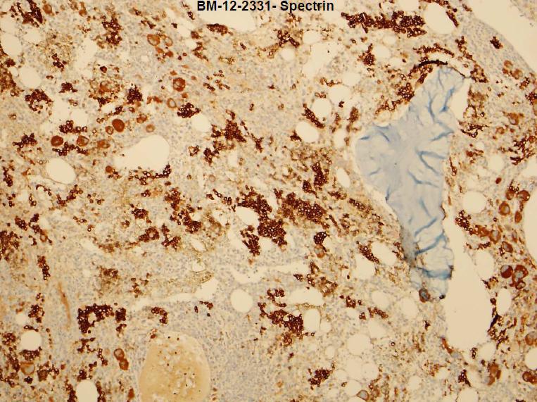 Third BM Biopsy Spectrin