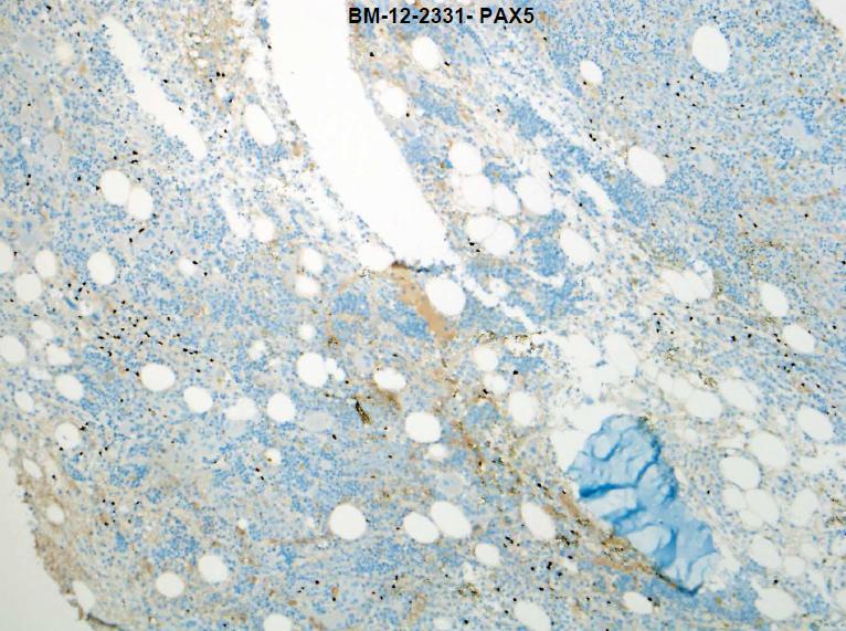 Third BM Biopsy PAX-5