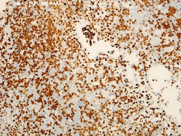Initial BM Biopsy PAX-5