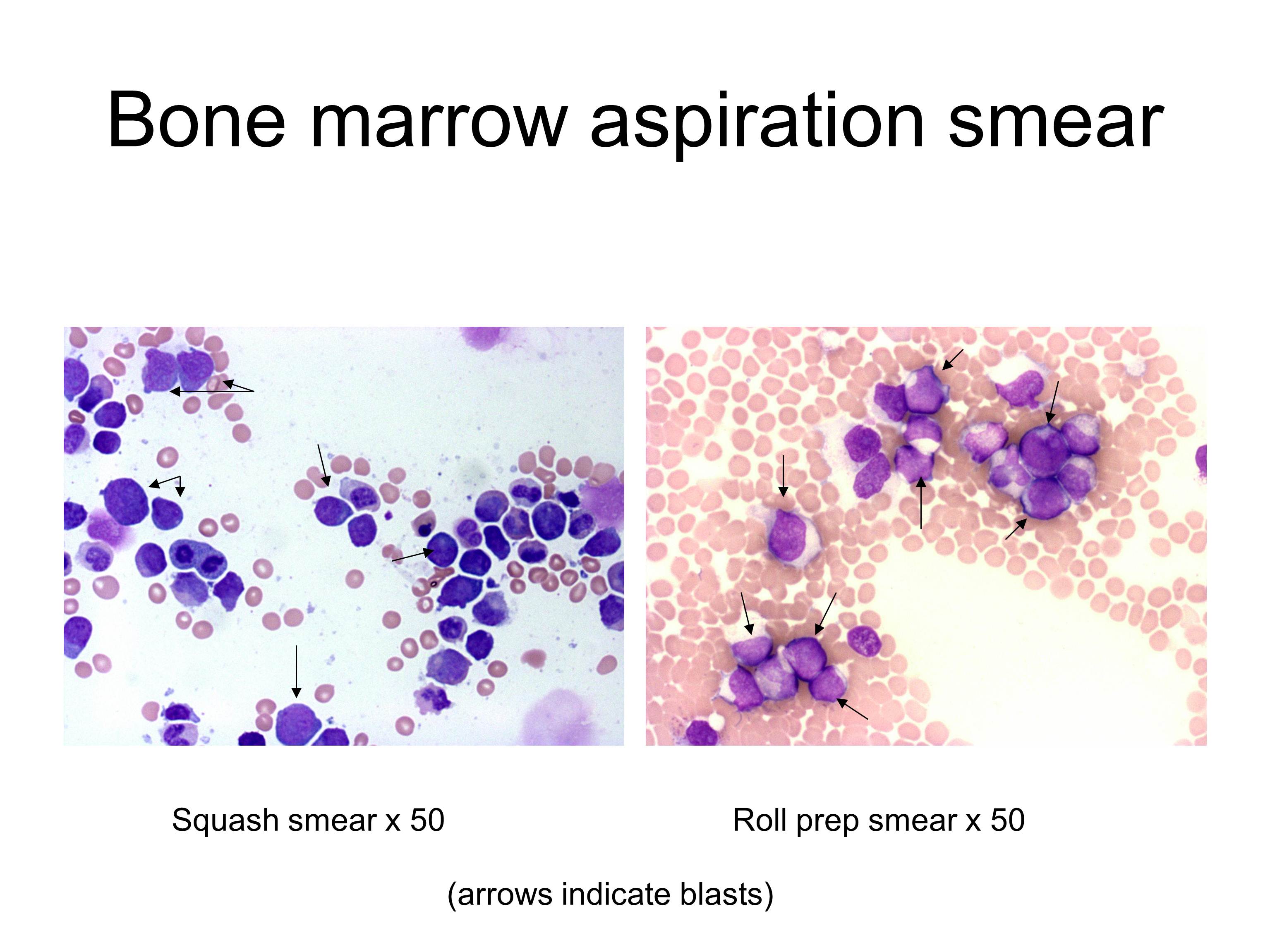 Additional figure 1: Bone marrow aspirate