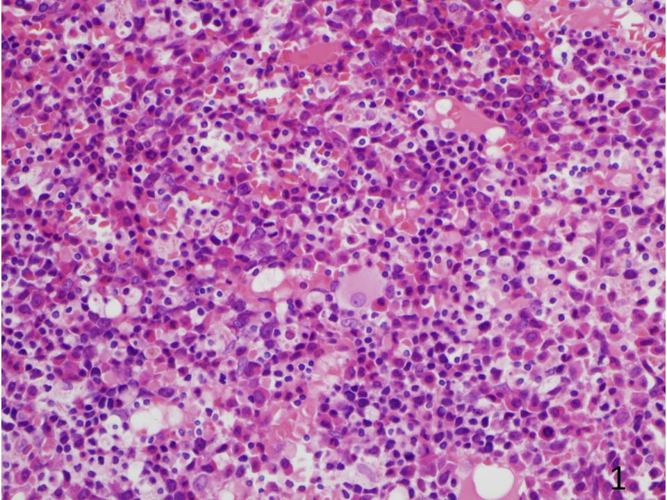 IMAGE 1 - Findings at the diagnosis of myelodysplastic syndrome, refractory anemia with excess blasts (RAEB-2); Bone Marrow Biopsy, 400X; Hypercellular and left shifted marrow with dysplastic megkaryocytes. 