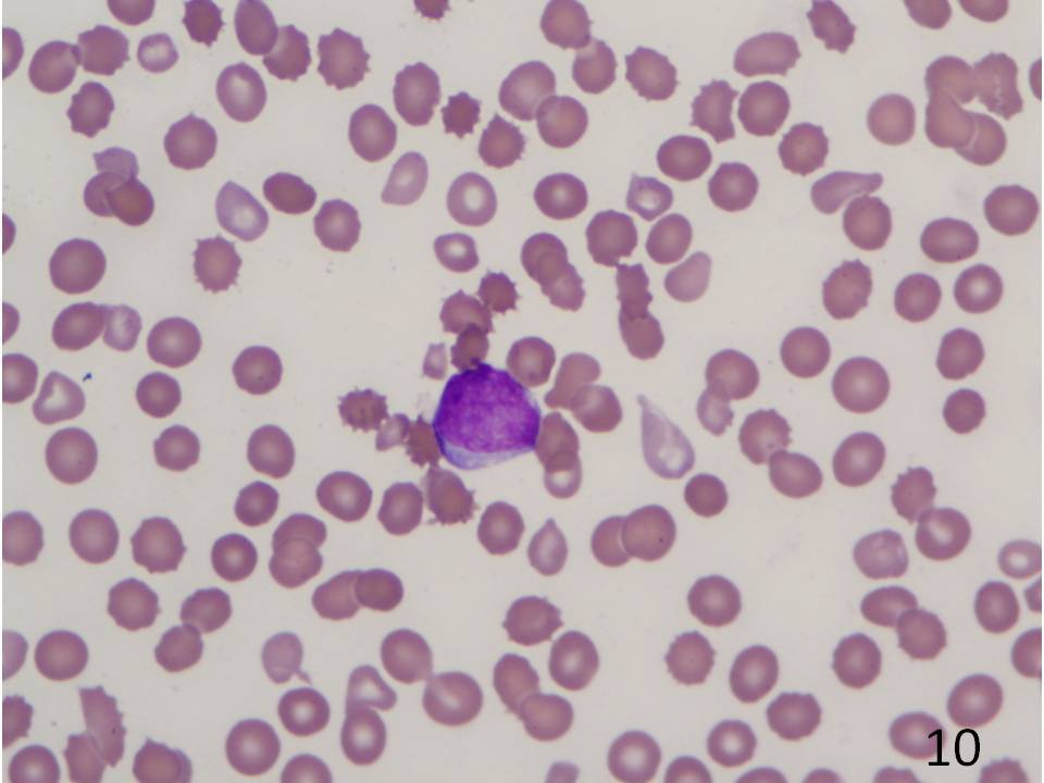 IMAGE 10 - Findings at transformation; Peripheral Blood, 1000X; Blasts.