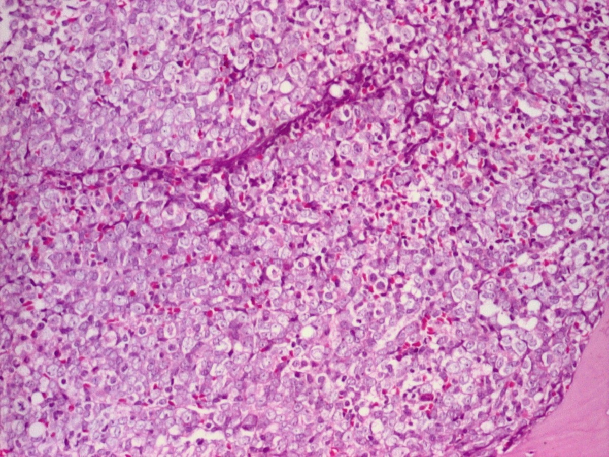 BM trephine biopsy 10x