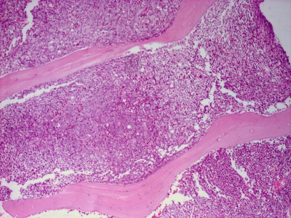BM trephine biopsy 4x