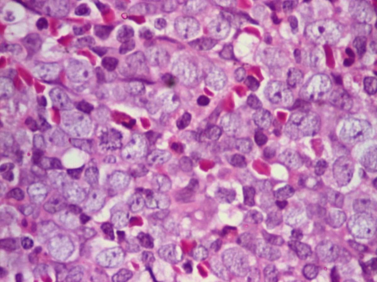 BM trephine biopsy 40x