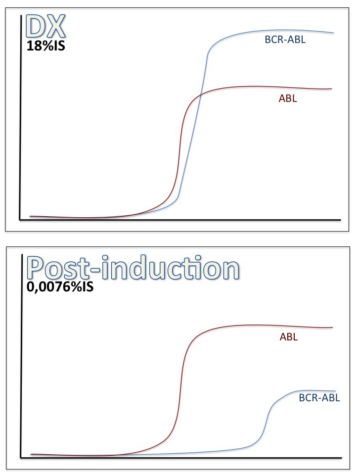 RT-PCR BCR/ABL