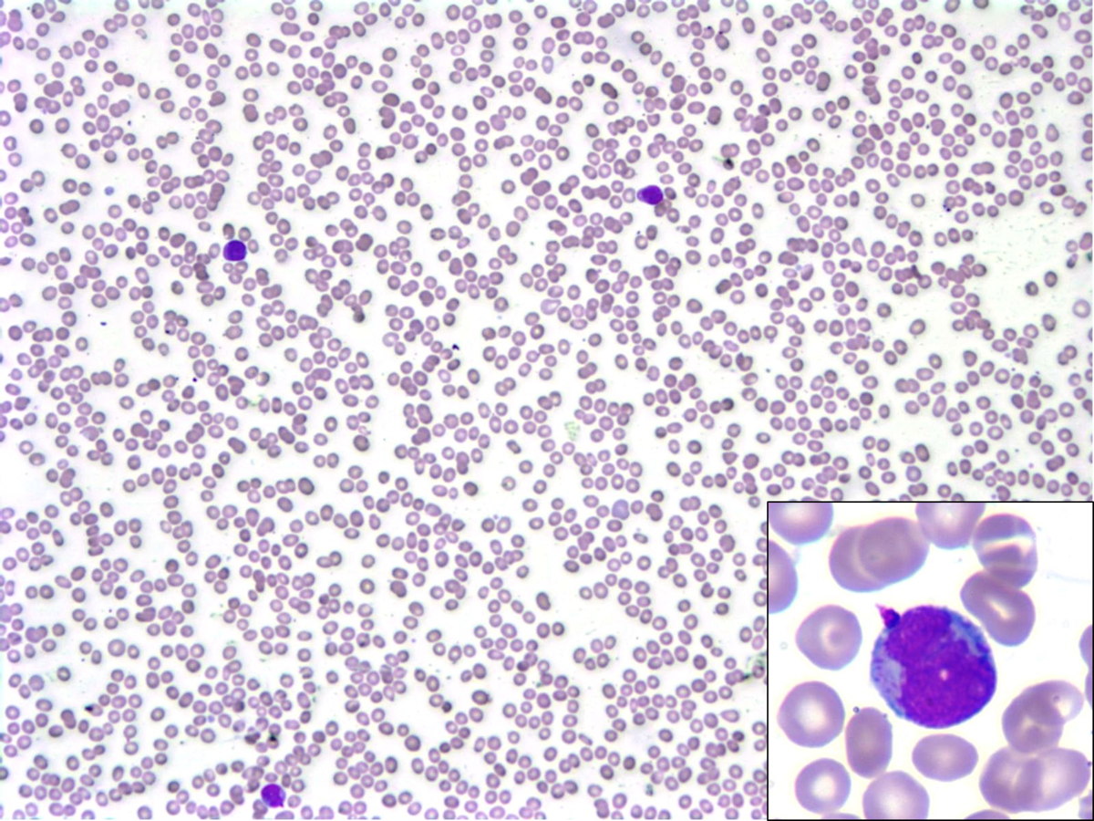 Peripheral blood smear (200x, 500x) demonstrating pancytopenia and circulating “blasts” with granules and biolobed nuclei.
