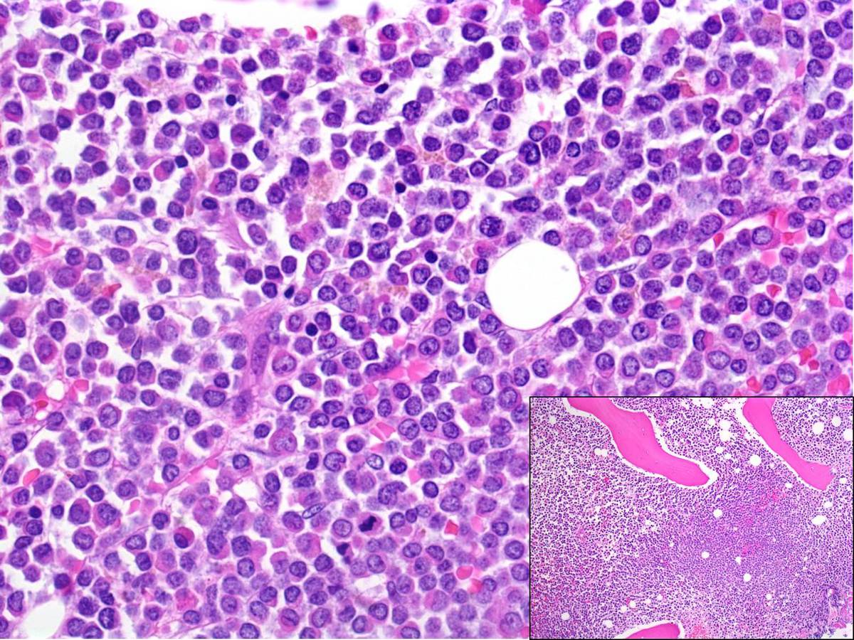Hypercellular bone marrow with sheets of immature granulocytic forms (100x, 400x).