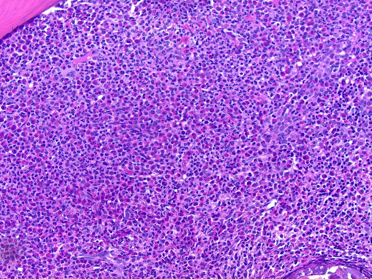 Bone marrow core biopsy, H&E; original magnification 200X