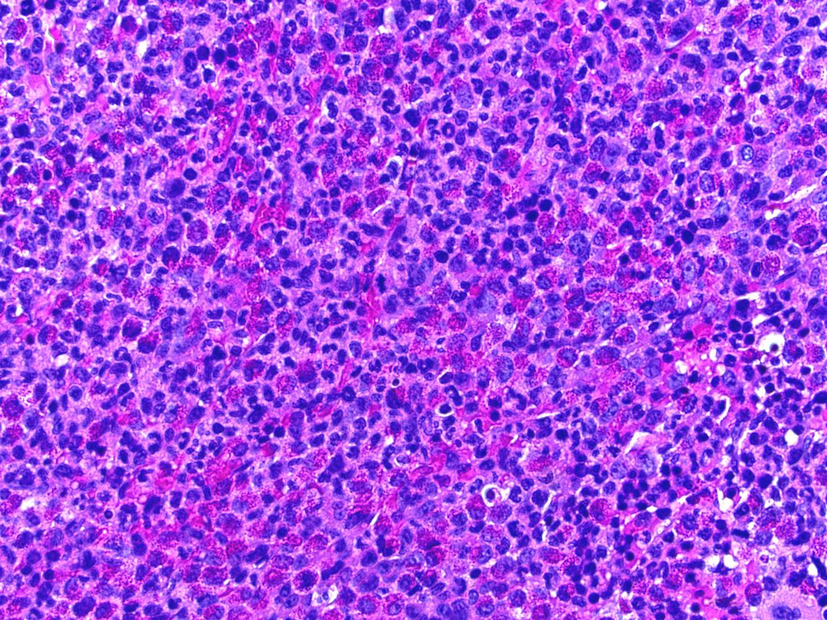 Bone marrow core biopsy, H&E; original magnification 400X