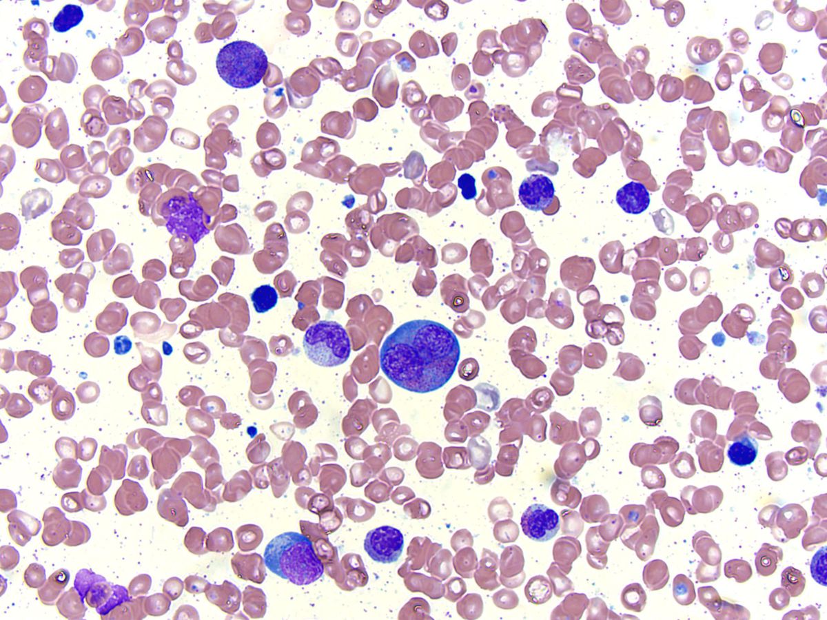 Bone marrow aspirate, Wright-Giemsa stain; original magnification 500X