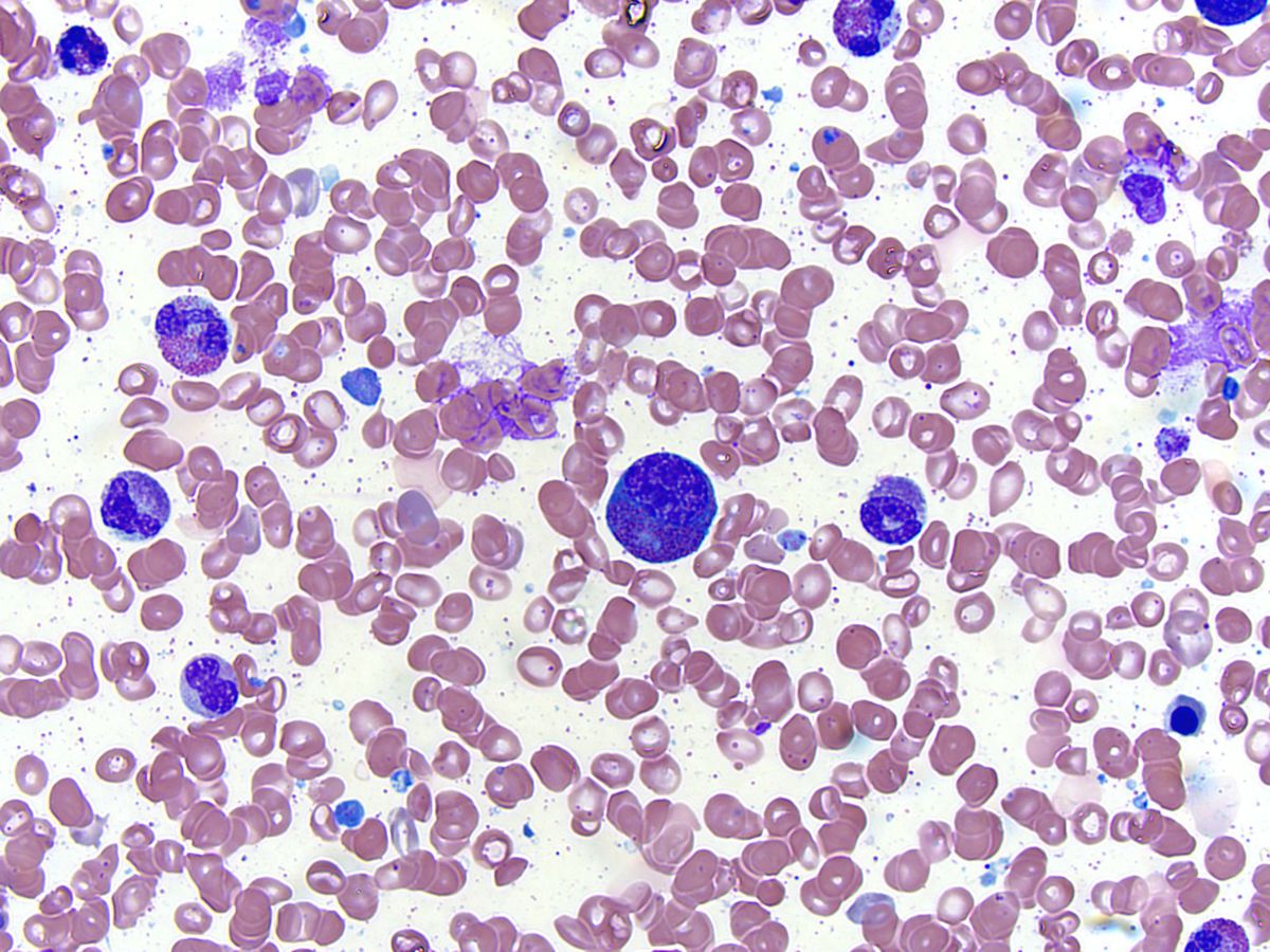 Bone marrow aspirate, Wright-Giemsa stain; original magnification 500X