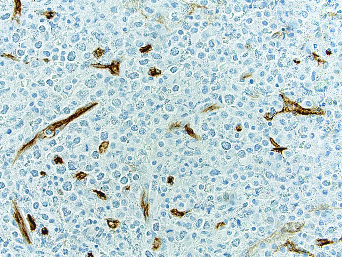 CD34 IHC; original magnification 400X: No increase in blasts; blood vessels as a positive internal control.