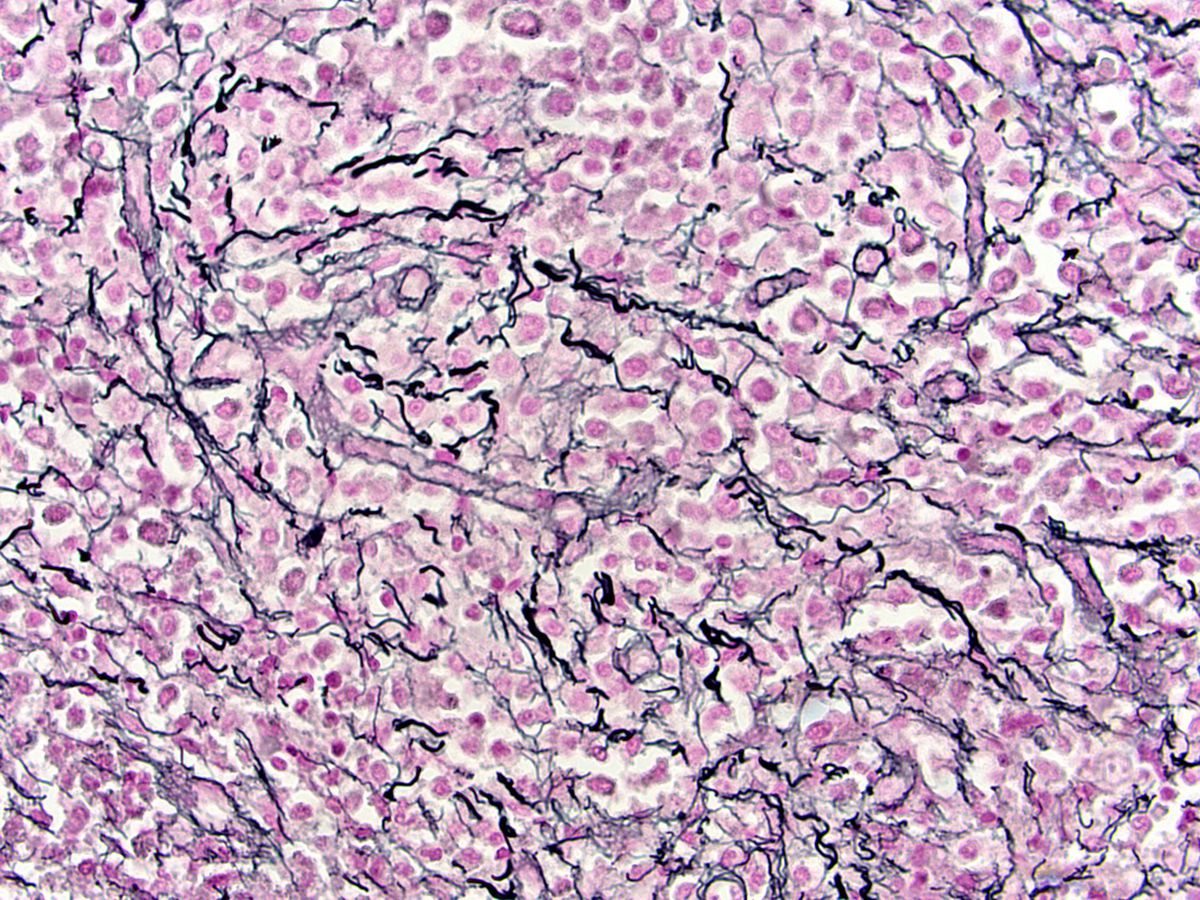 Reticulin cytochemical stain; original magnification 400X