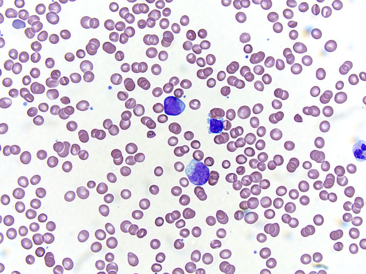Peripheral smear; original magnification 500X