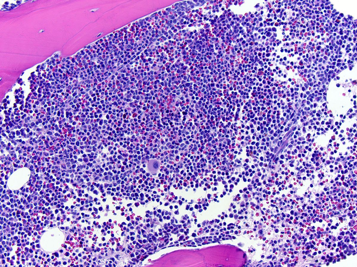 Bone marrow biopsy, H&E; original magnification 200X