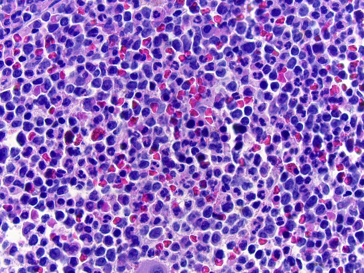 Bone marrow biopsy, H&E; original magnification 500X