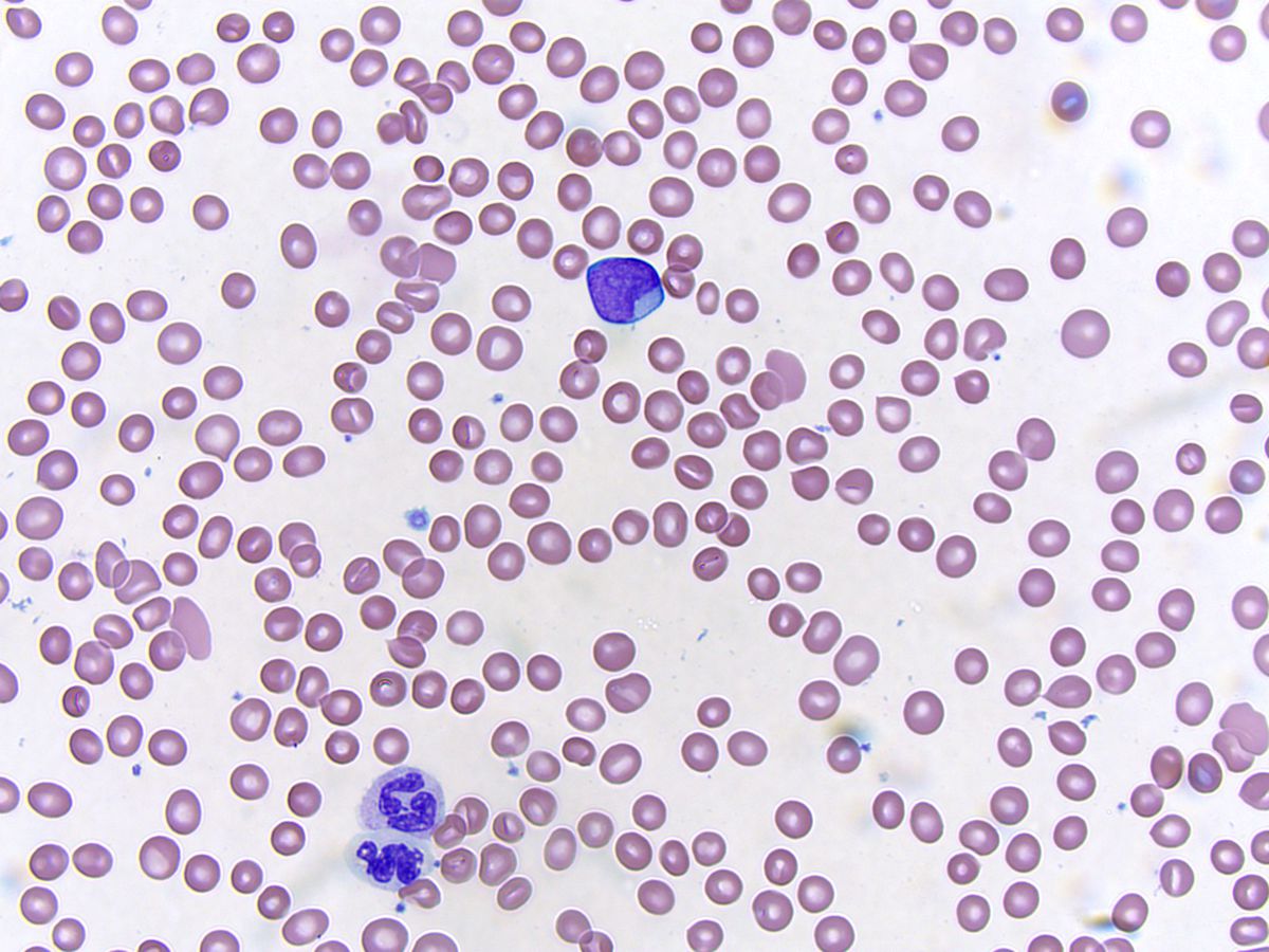Peripheral smear; original magnification 500X: Blast and dysplastic granulocytes