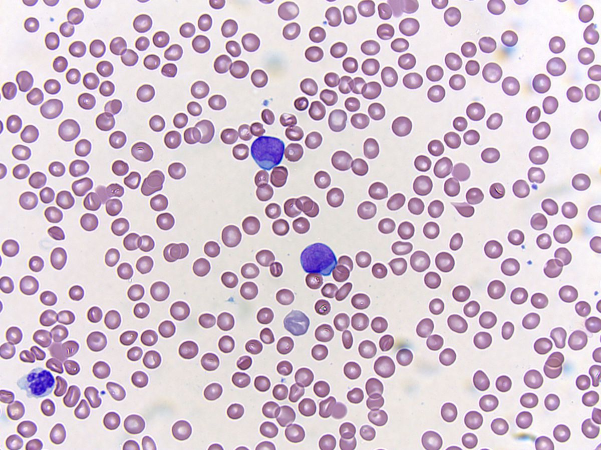 Peripheral smear; original magnification 500X: Blasts and dysplastic granulocyte
