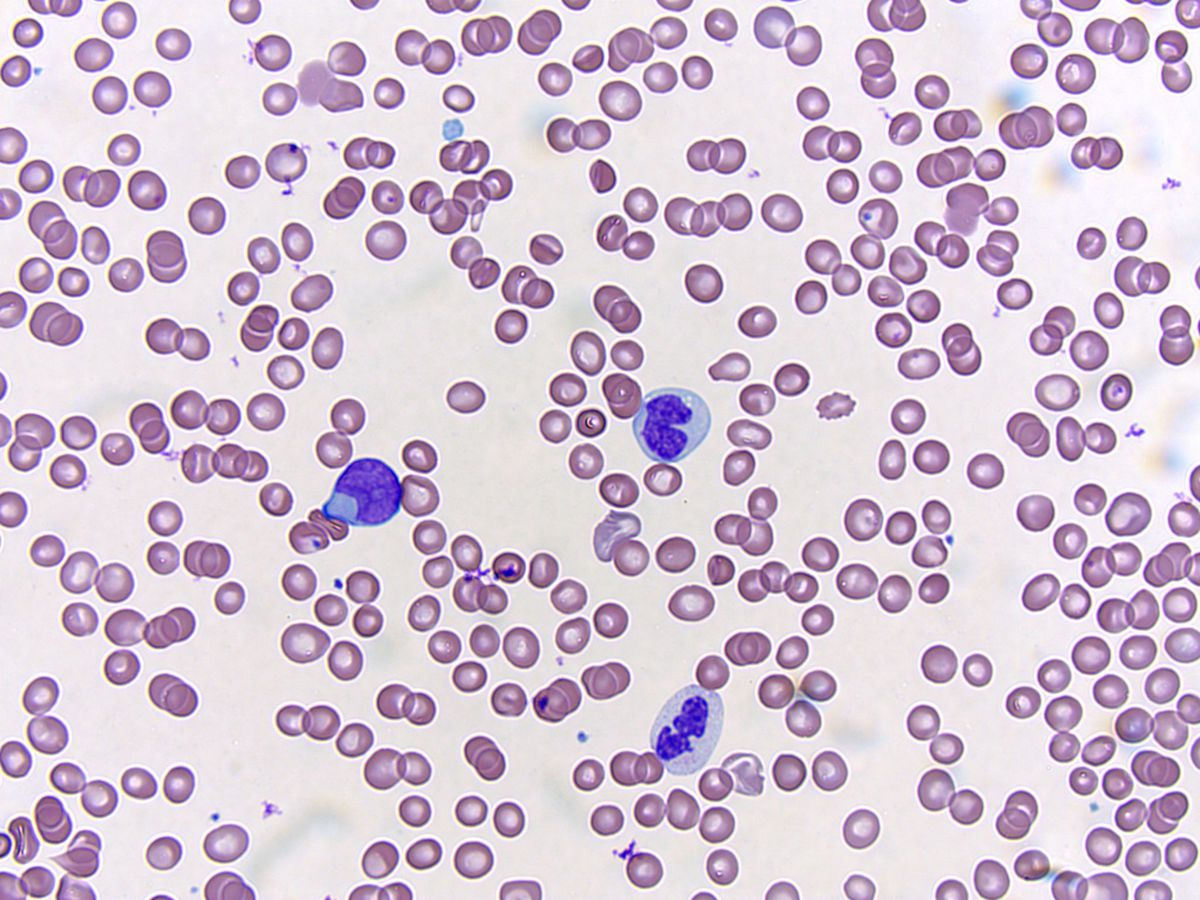 Peripheral smear; original magnification 500X: Blast, monocyte and dysplastic granulocyte