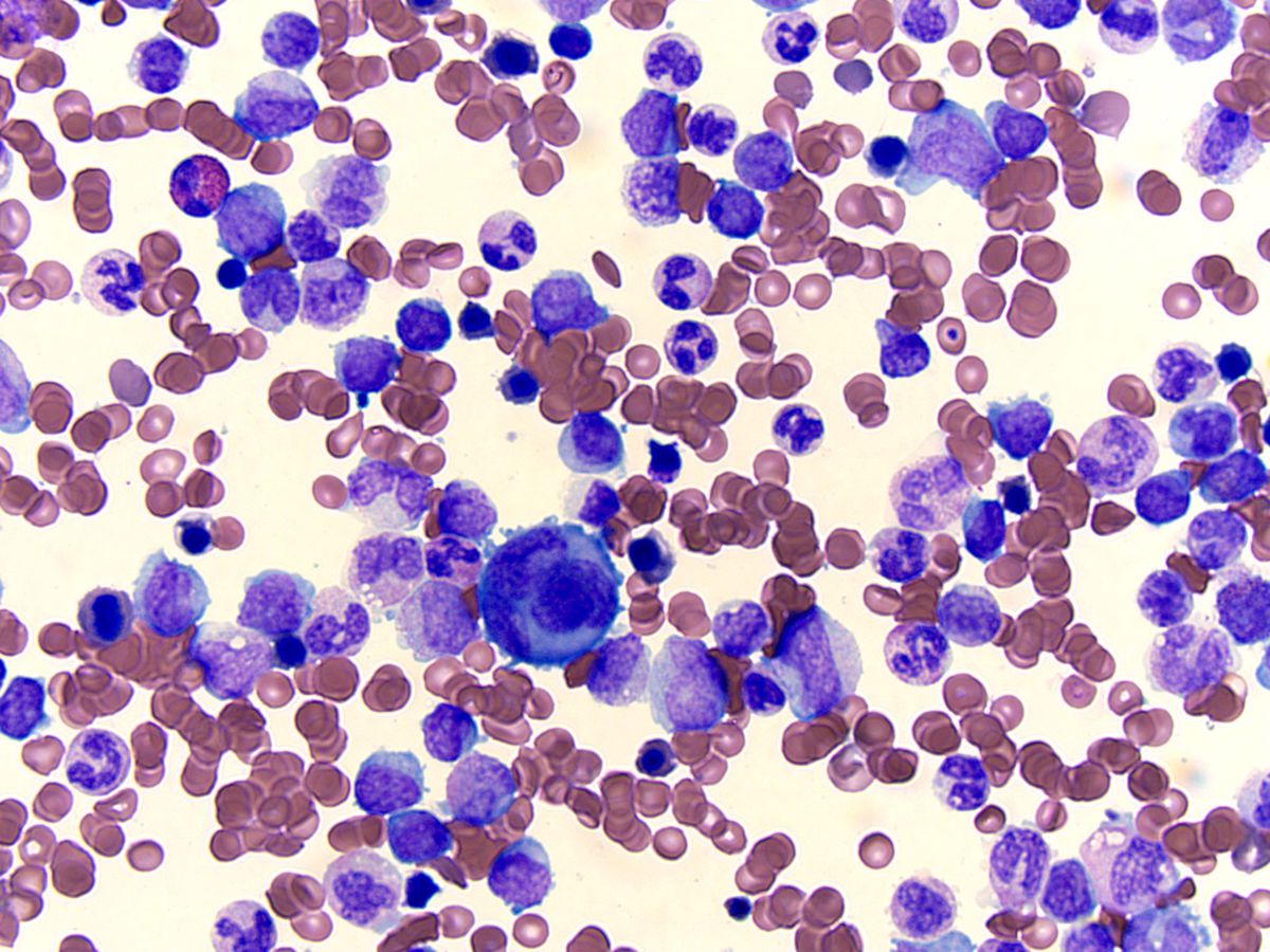 Bone marrow aspirate, Wright-Giemsa; original magnification 500X: Blasts, dysgranulopoiesis, dyserythropoiesis and dysplastic megakaryocyte (center)