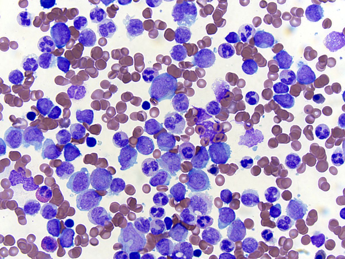 Bone marrow aspirate, Wright-Giemsa; original magnification 500X: