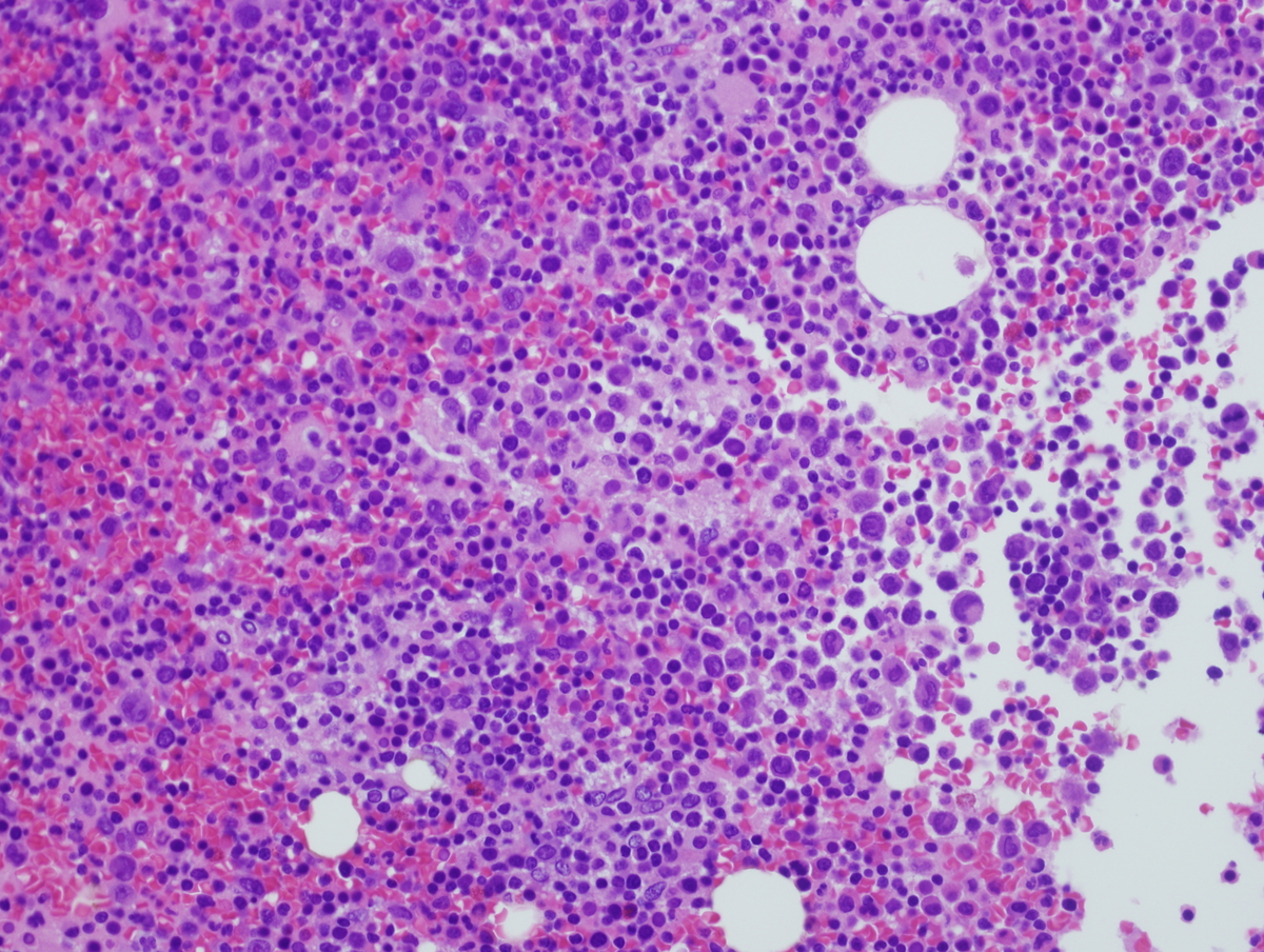Figure 4.  H&E stained section of the bone marrow biopsy unilaterally focally involved by AML, 400X
