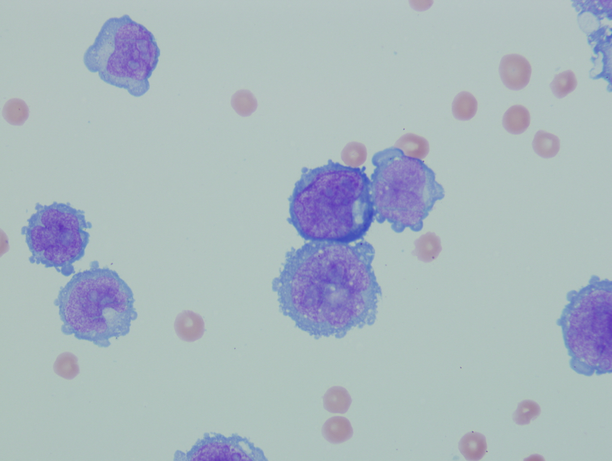 Figure 1. Wright stained CSF cytospin showing abnormal immature monocytic cells.