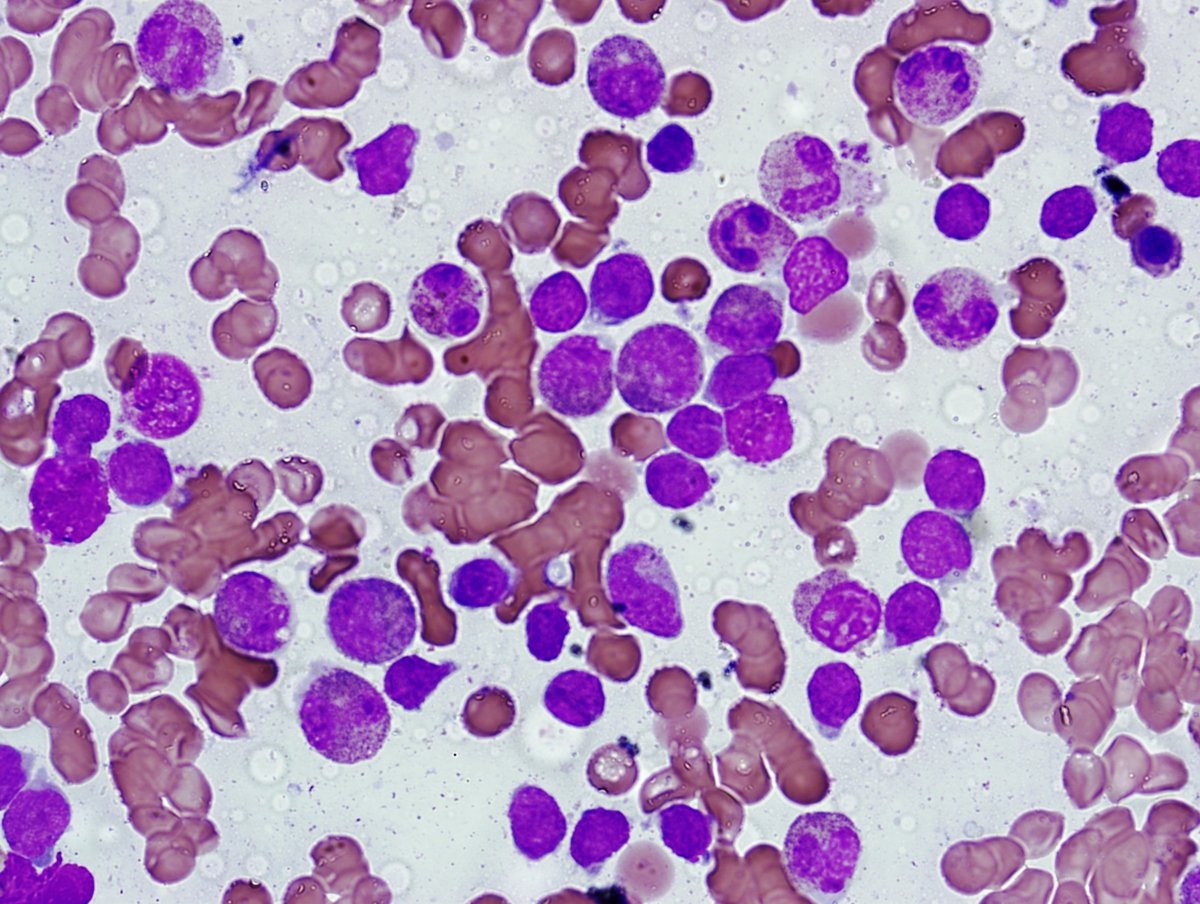 Bone marrow aspirate (100X) from 12/30/2011