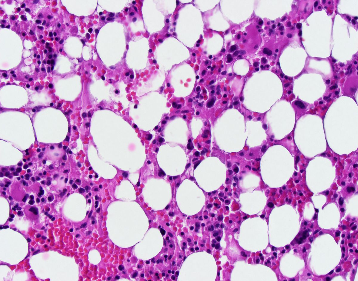 Bone marrow clot section: Hypocellular marrow with increased, clustered and dysplastic megakaryocytes, reduced erythropoiesis and virtually no myelopoiesis.