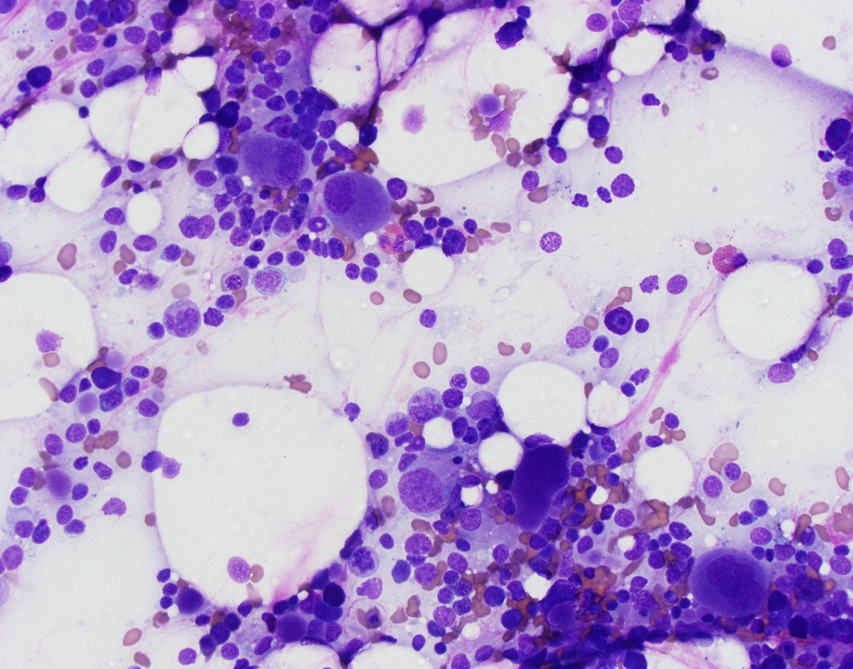 Bone marrow aspirate: Numerous small and/or mononuclear megakaryocytes, few erythoid precursors and virtually no myeloid precursors.