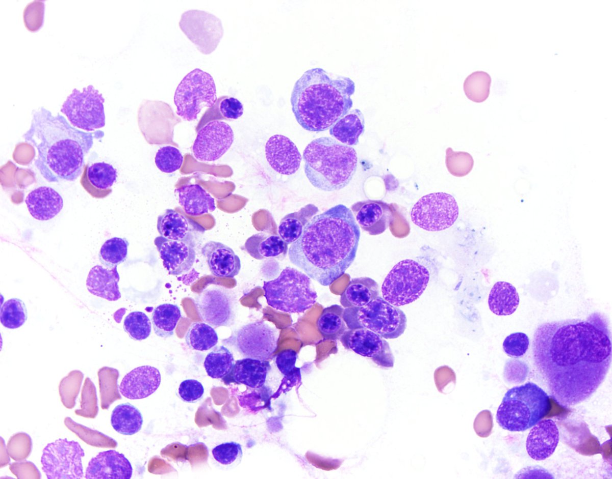 Bone marrow aspirate smear: Megaloblastic erythropoieis.