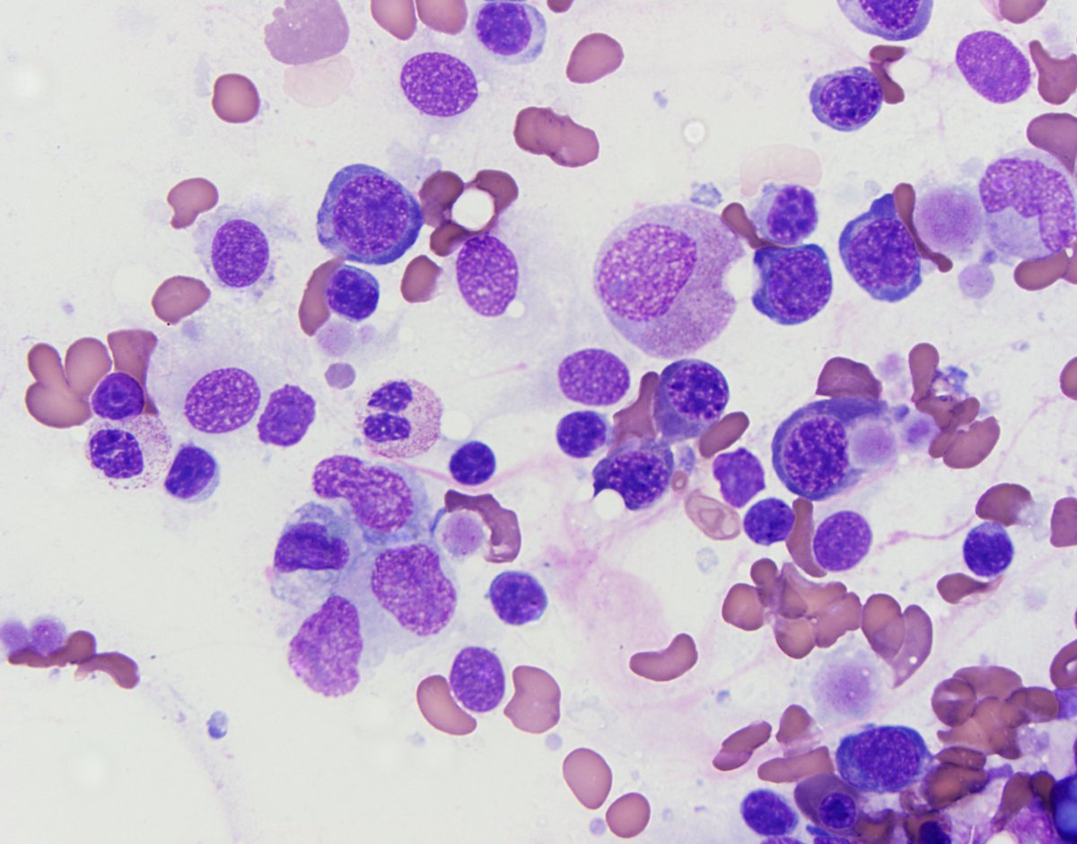 Bone marrow aspirate: Extremely limited granulopoiesis including a bilobed neutrophil.
