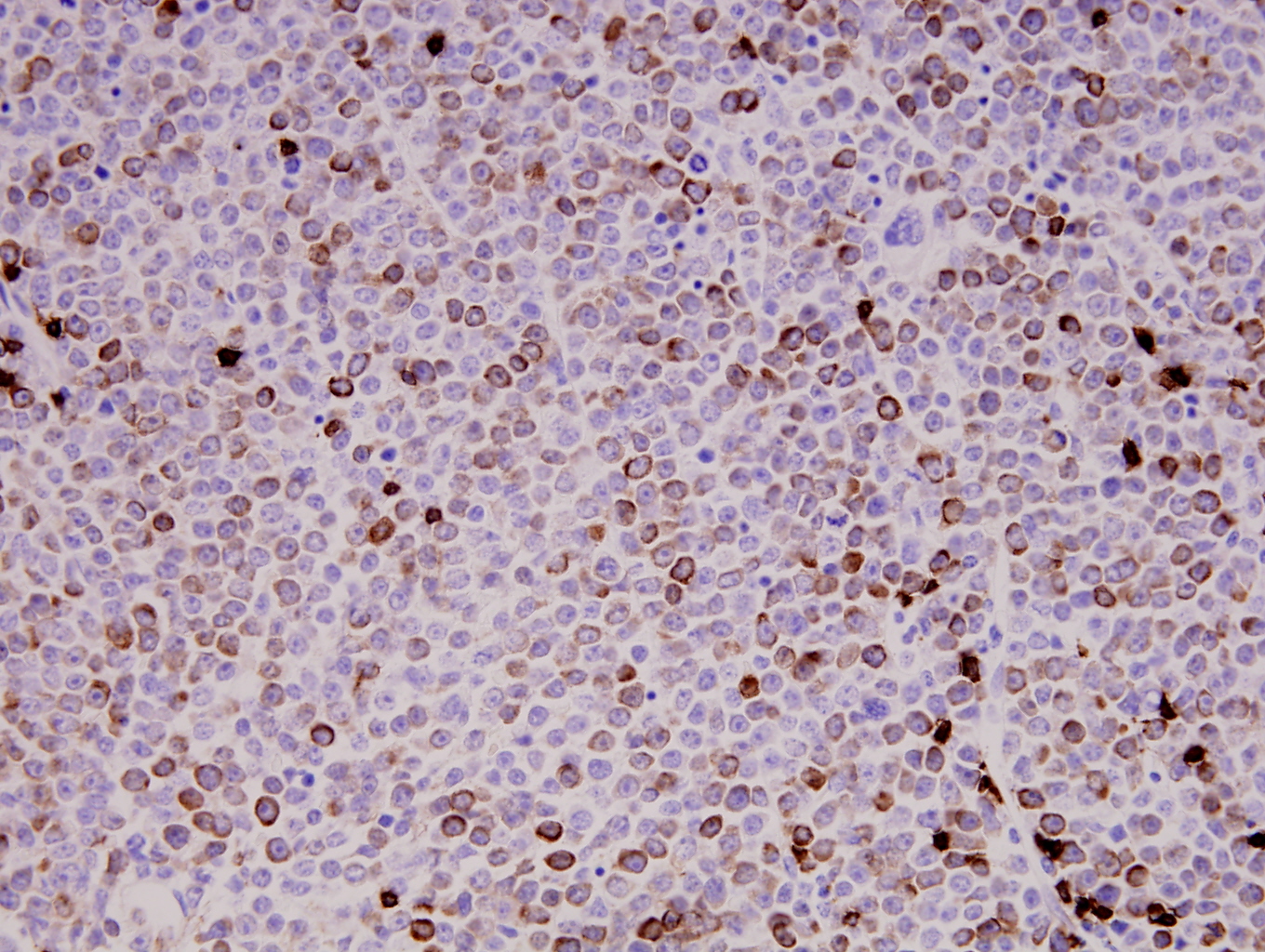 Additional figure 2: CD3 IHC, 400x