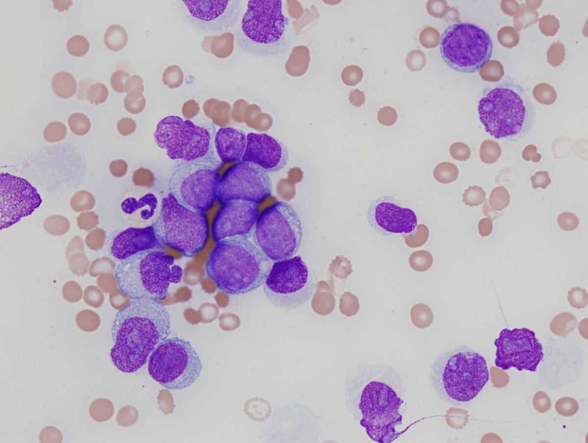 Bone marrow aspirate