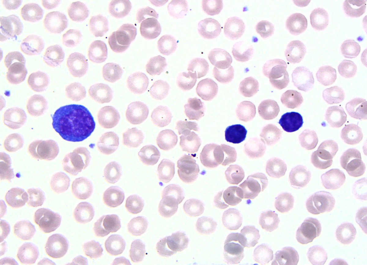 Peripheral blood: Typical lymphoblasts (right) and a large cell with coarse chromatin and dense blue cytoplasm (left) blast vs. lymphoma cell.