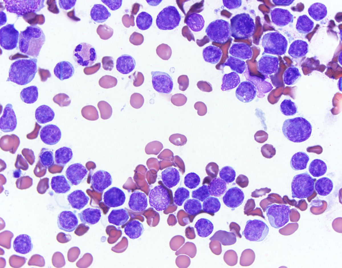 Bone marrow: Many small to intermediate-sized blasts, a few larger blasts and occasional fine cytoplasmic vacuoles.