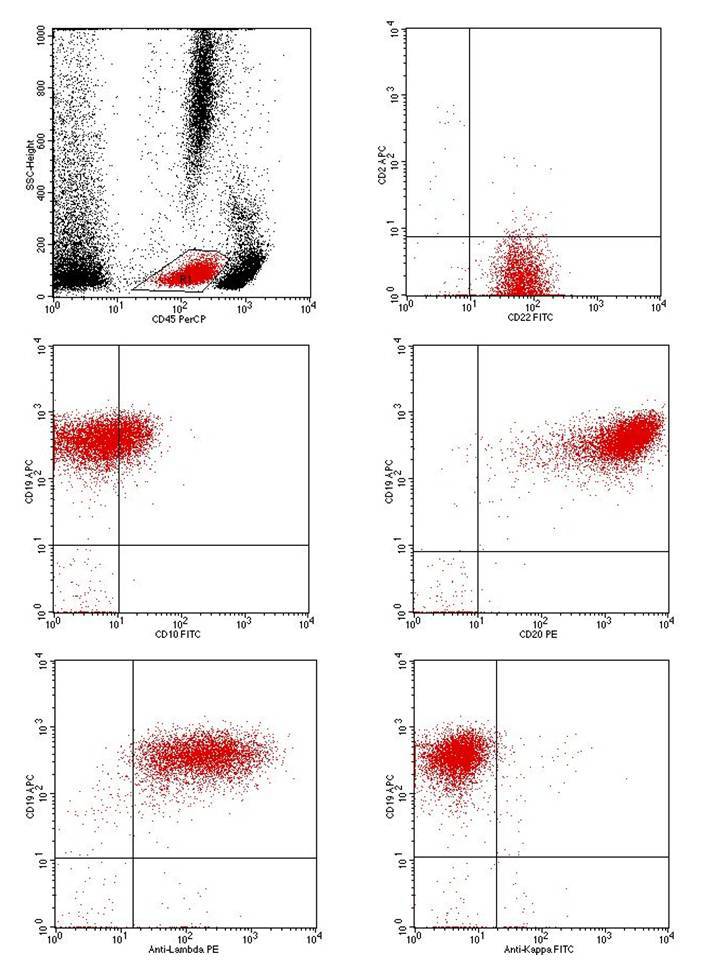 Flow cytometry from blood: Mature B-cell phenotype positive for CD19, sCD22, sLambda-restricted, but only dim CD10. Notice dim CD45.
